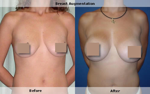 Breast augmentation, breast enlargement , implants
